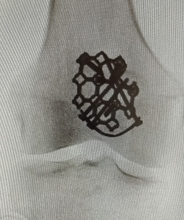 P.S.  X-ray of Jane's kneecap (plus hardware) two weeks later.